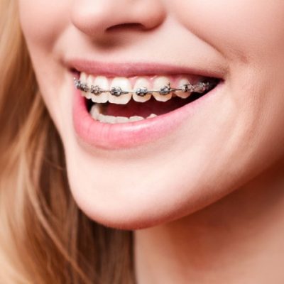 brackets (Pequeño)