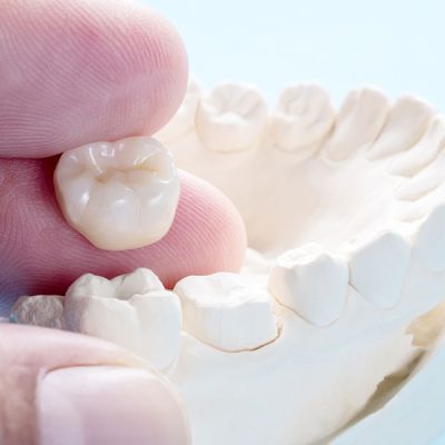 coronas-dentales-de-porcelanacuando-son-necesarias