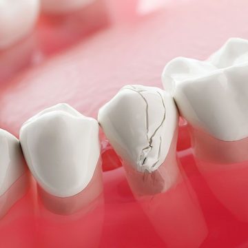 resin-dental-filling-tijuana-ff81de3d